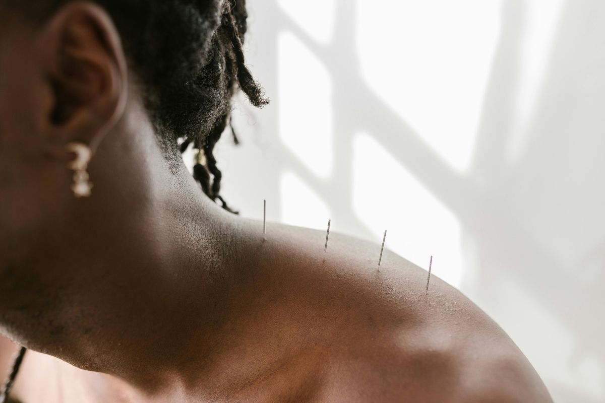 Does Medicare Pay For Acupuncture for Any Treatments?