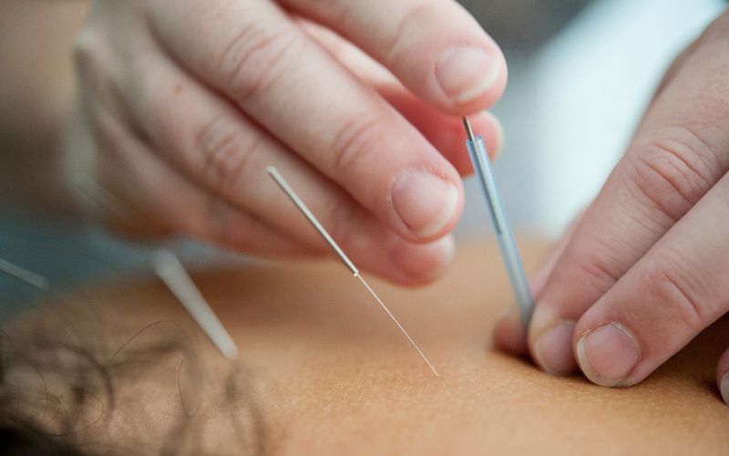 does-medicare-cover-acupuncture-what-you-pay